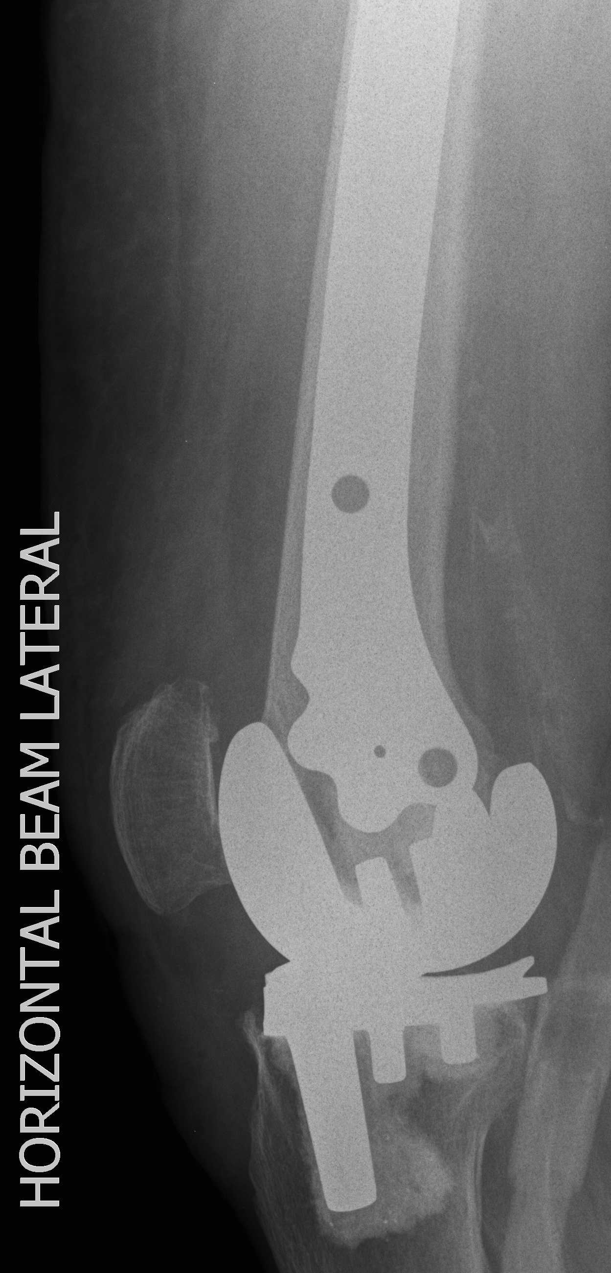 TKR Periprosthetic Fracture Locking Plate Lateral